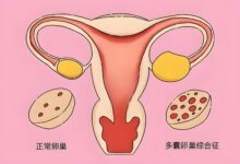 多囊卵巢综合征与艾灸疗法：改善生活规律，促进健康