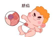 艾灸治疗小儿脐疝