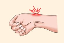 艾灸能治疗腱鞘囊肿吗？方法和经验分享